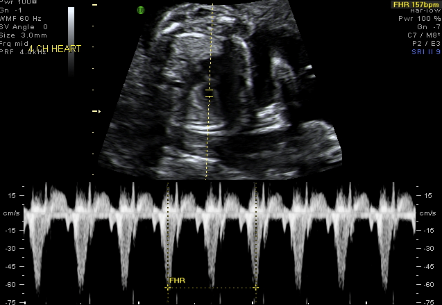 Leila's Ultrasound, showing heartbeat